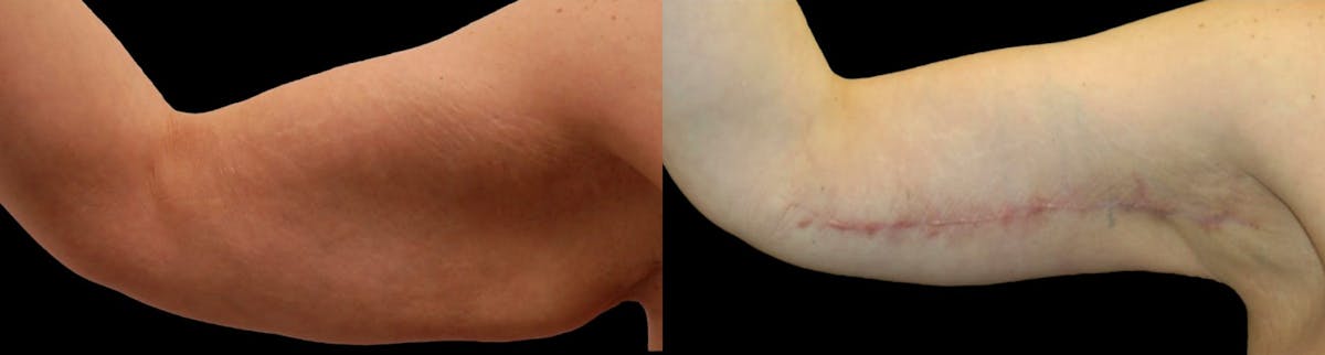 Arm Lift Before & After Gallery - Patient 226409 - Image 4