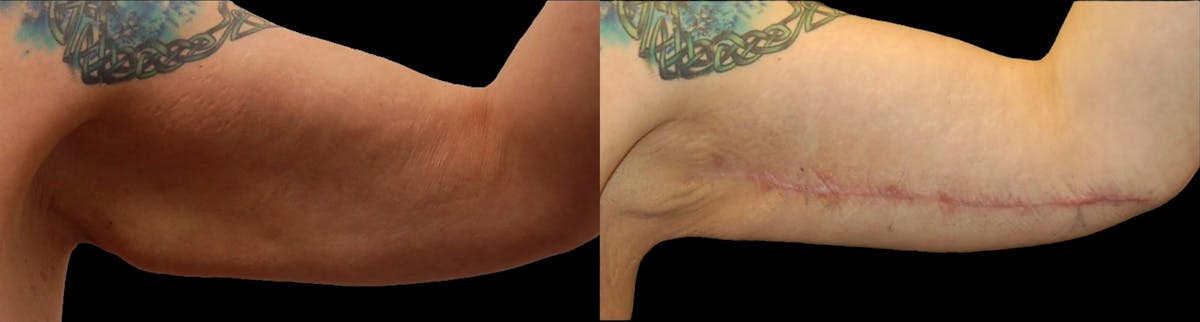 Arm Lift Before & After Gallery - Patient 226409 - Image 2