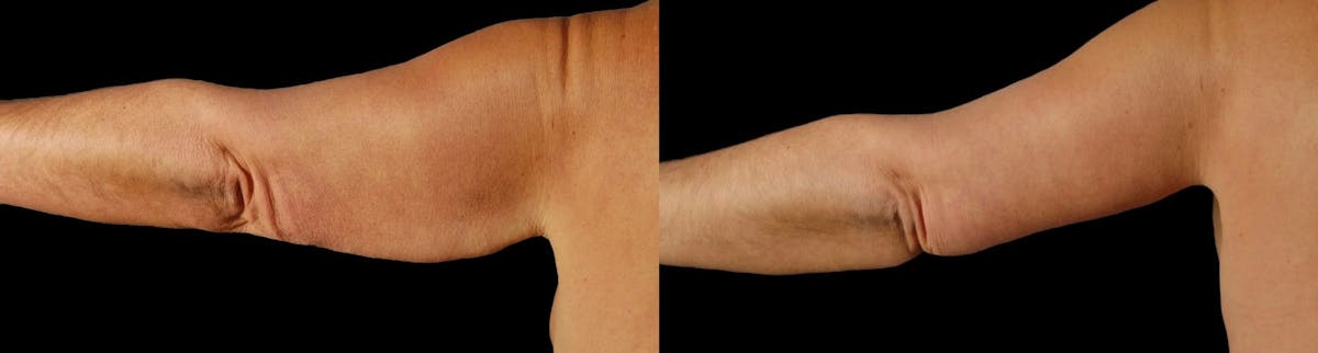 Arm Lift Before & After Gallery - Patient 225099 - Image 5