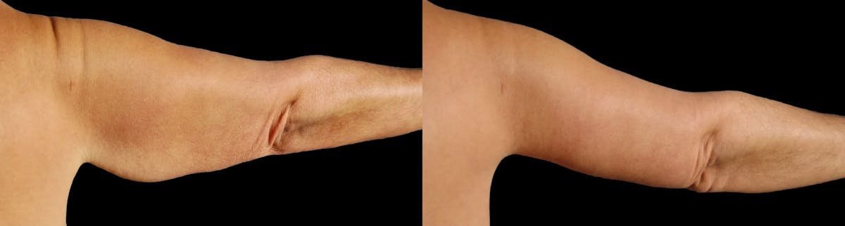 Arm Lift Before & After Gallery - Patient 225099 - Image 4