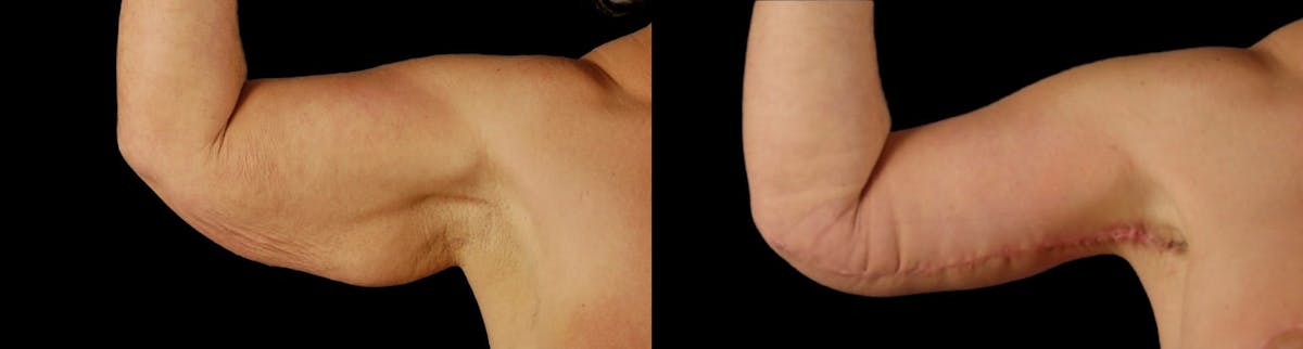 Arm Lift Before & After Gallery - Patient 225099 - Image 2