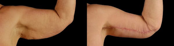 Arm Lift Before & After Gallery - Patient 225099 - Image 1