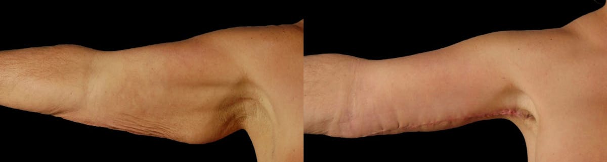 Arm Lift Before & After Gallery - Patient 225099 - Image 8