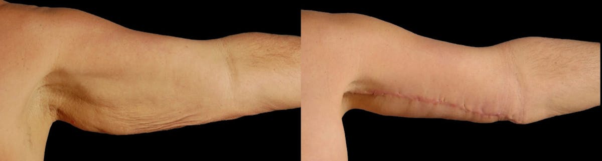 Arm Lift Before & After Gallery - Patient 225099 - Image 3