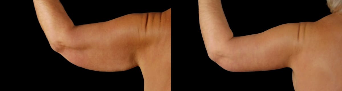 Arm Lift Before & After Gallery - Patient 225099 - Image 7