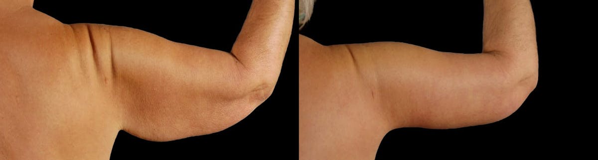 Arm Lift Before & After Gallery - Patient 225099 - Image 6
