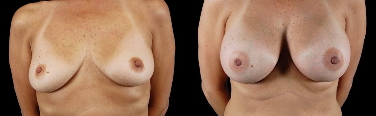 Breast Augmentation Before & After Gallery - Patient 318392 - Image 5