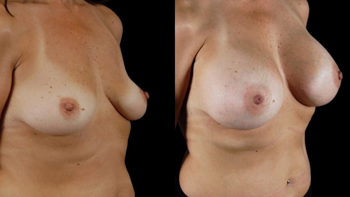 Breast Augmentation Before & After Gallery - Patient 318392 - Image 4