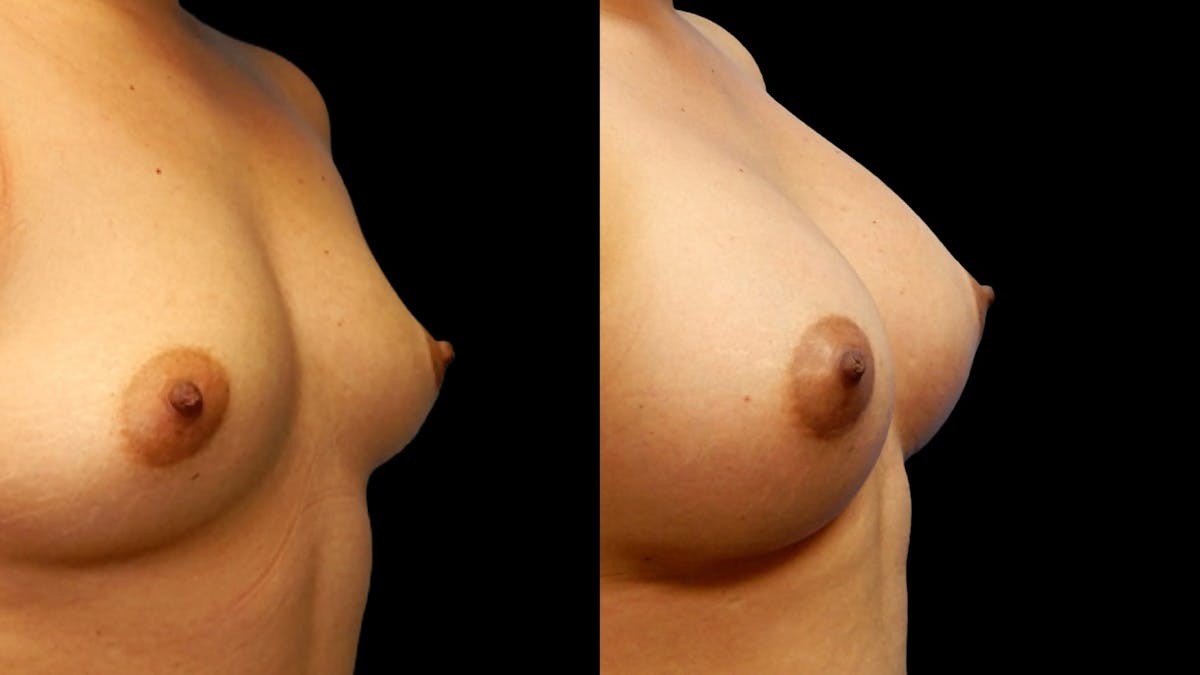 Breast Augmentation Before & After Gallery - Patient 196821 - Image 1