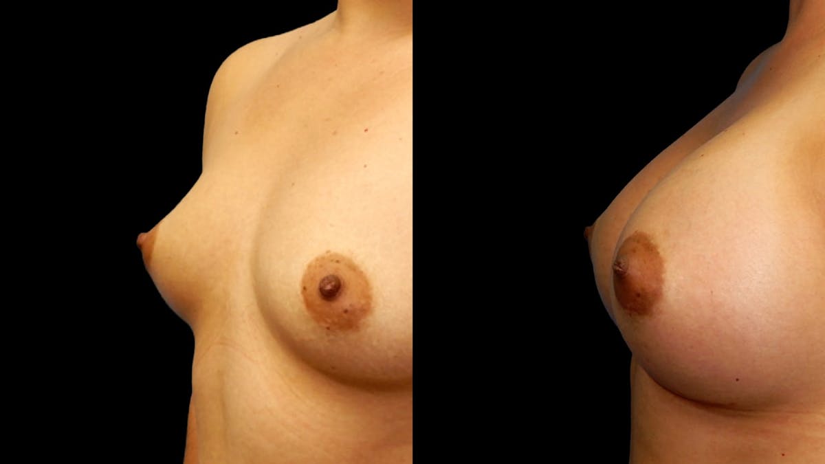 Breast Augmentation Before & After Gallery - Patient 196821 - Image 2