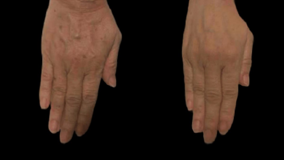 CO2 Lift Pro Mask Before & After Gallery - Patient 216477 - Image 1