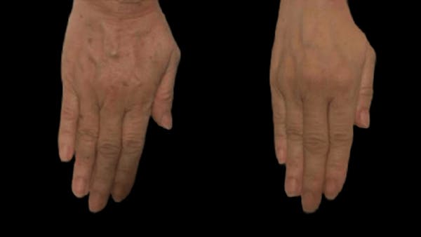 CO2 Lift Pro Mask Before & After Gallery - Patient 216477 - Image 1
