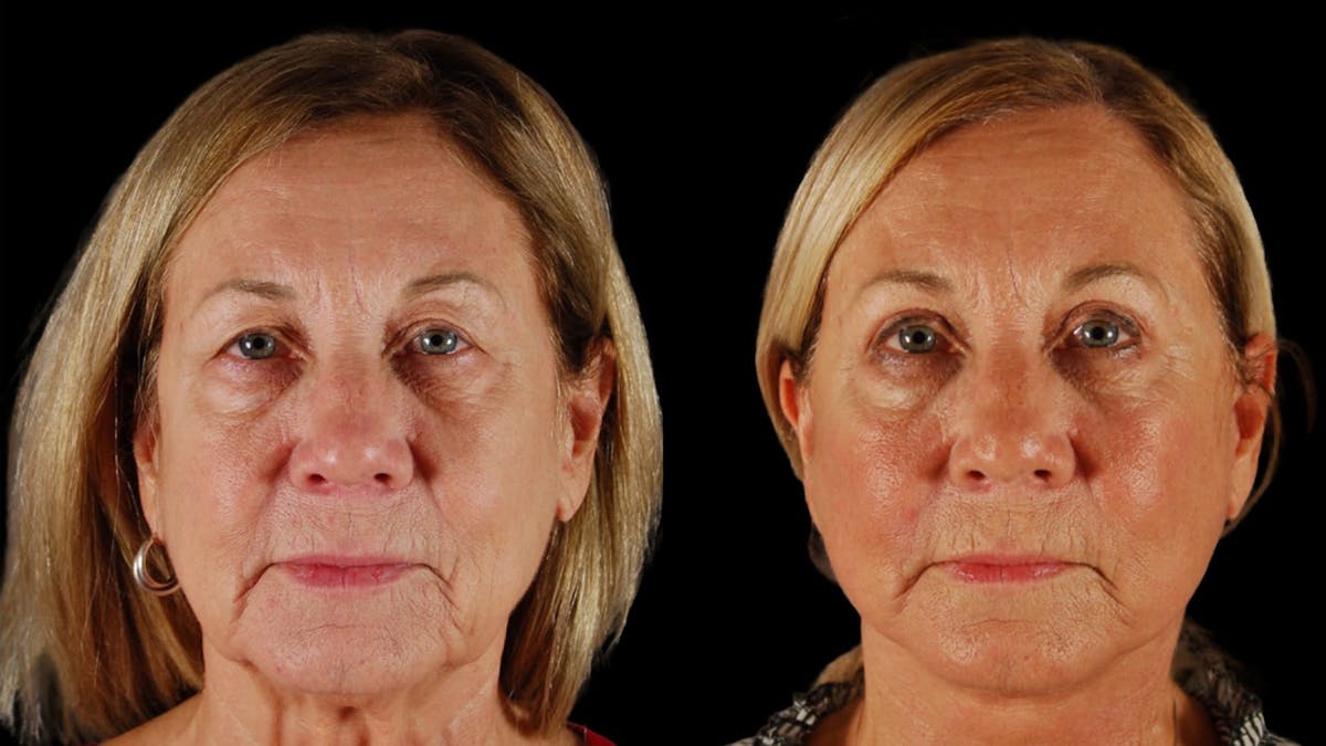 Neck Lift Before & After Gallery - Patient 271564 - Image 1