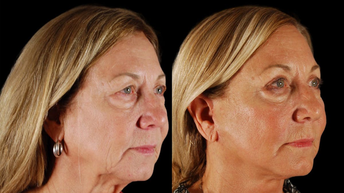 Neck Lift Before & After Gallery - Patient 271564 - Image 4