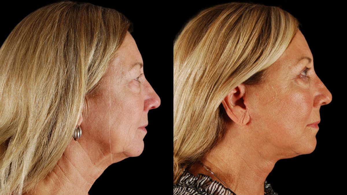 Neck Lift Before & After Gallery - Patient 271564 - Image 5