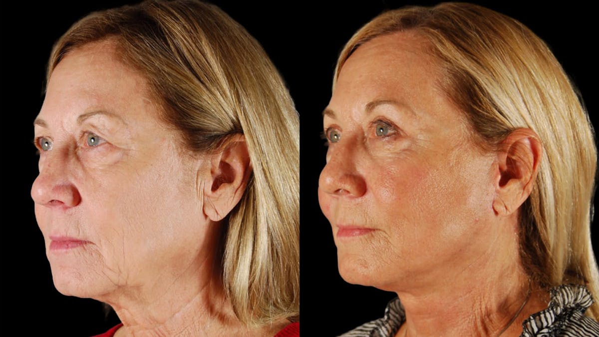 Neck Lift Before & After Gallery - Patient 271564 - Image 2