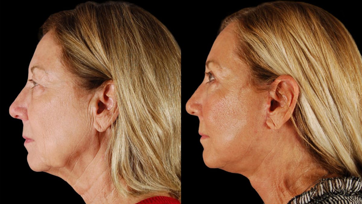 Neck Lift Before & After Gallery - Patient 271564 - Image 3