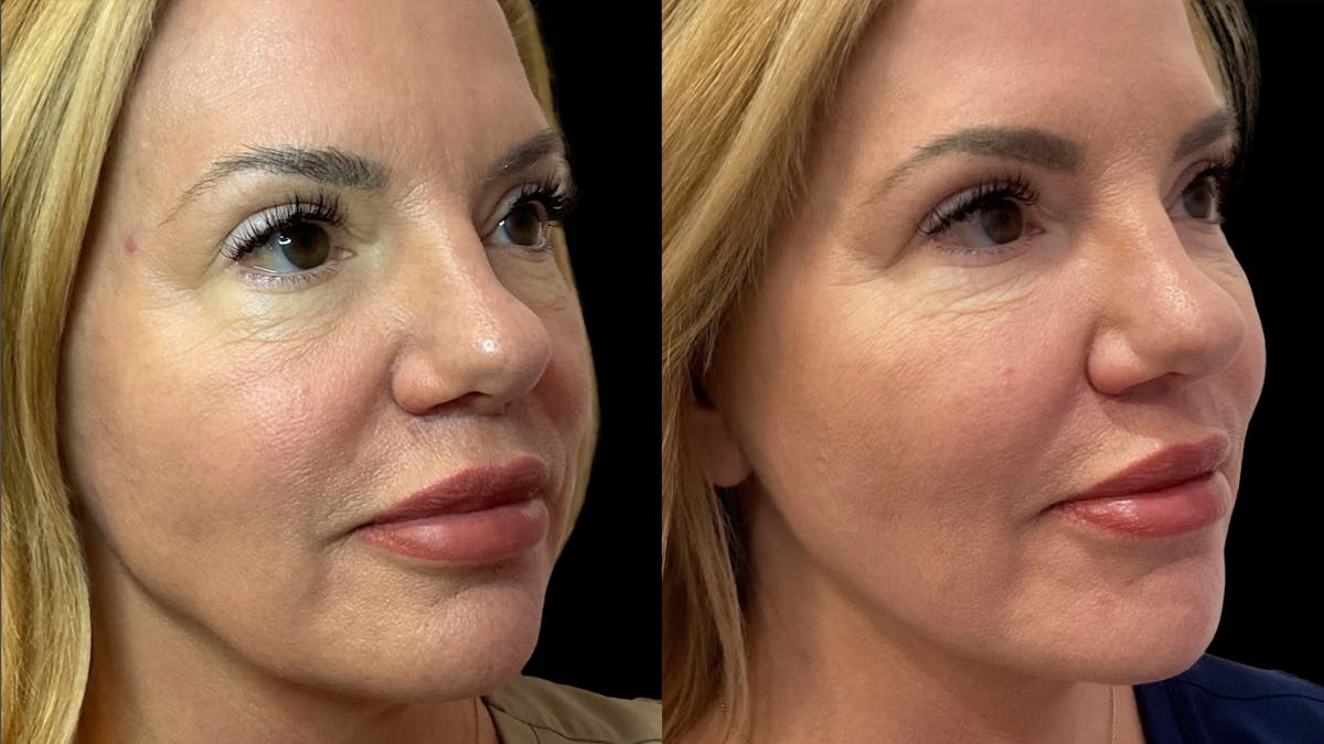 Dermal Filler Before & After Gallery - Patient 320209 - Image 2