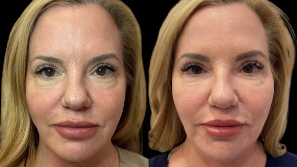 Dermal Filler Before & After Gallery - Patient 320209 - Image 1