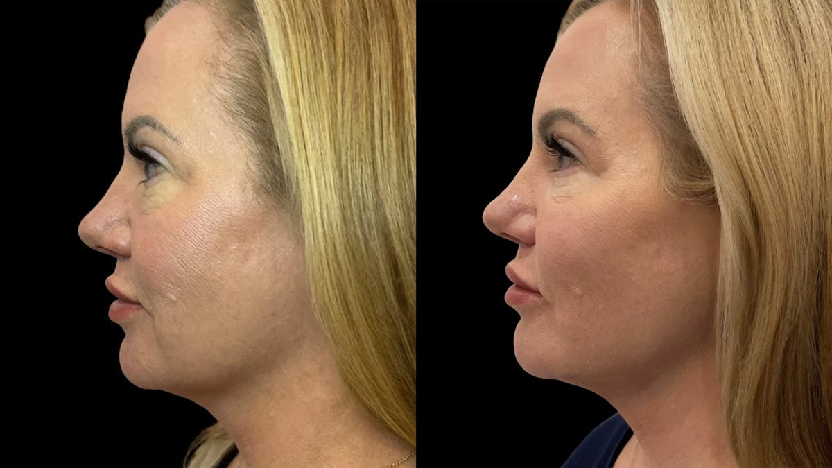 Dermal Filler Before & After Gallery - Patient 320209 - Image 3