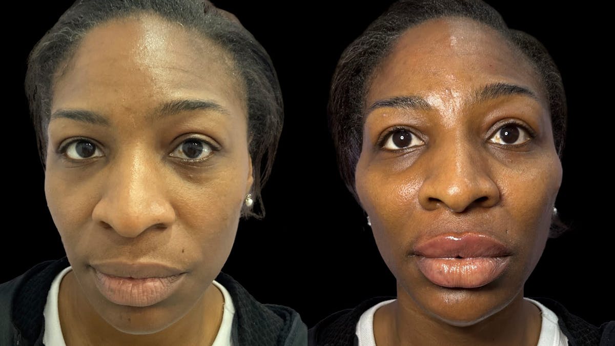 Dermal Filler Before & After Gallery - Patient 324589 - Image 1
