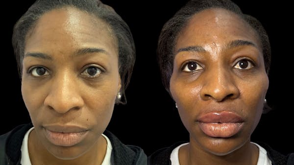 Dermal Filler Before & After Gallery - Patient 324589 - Image 1