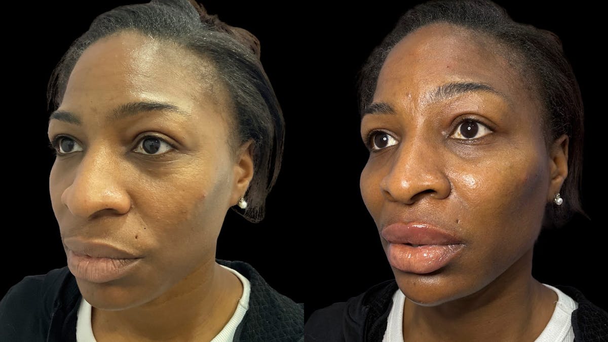 Dermal Filler Before & After Gallery - Patient 324589 - Image 4