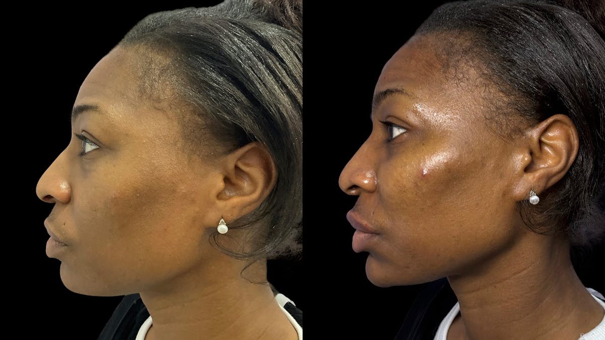 Dermal Filler Before & After Gallery - Patient 324589 - Image 5