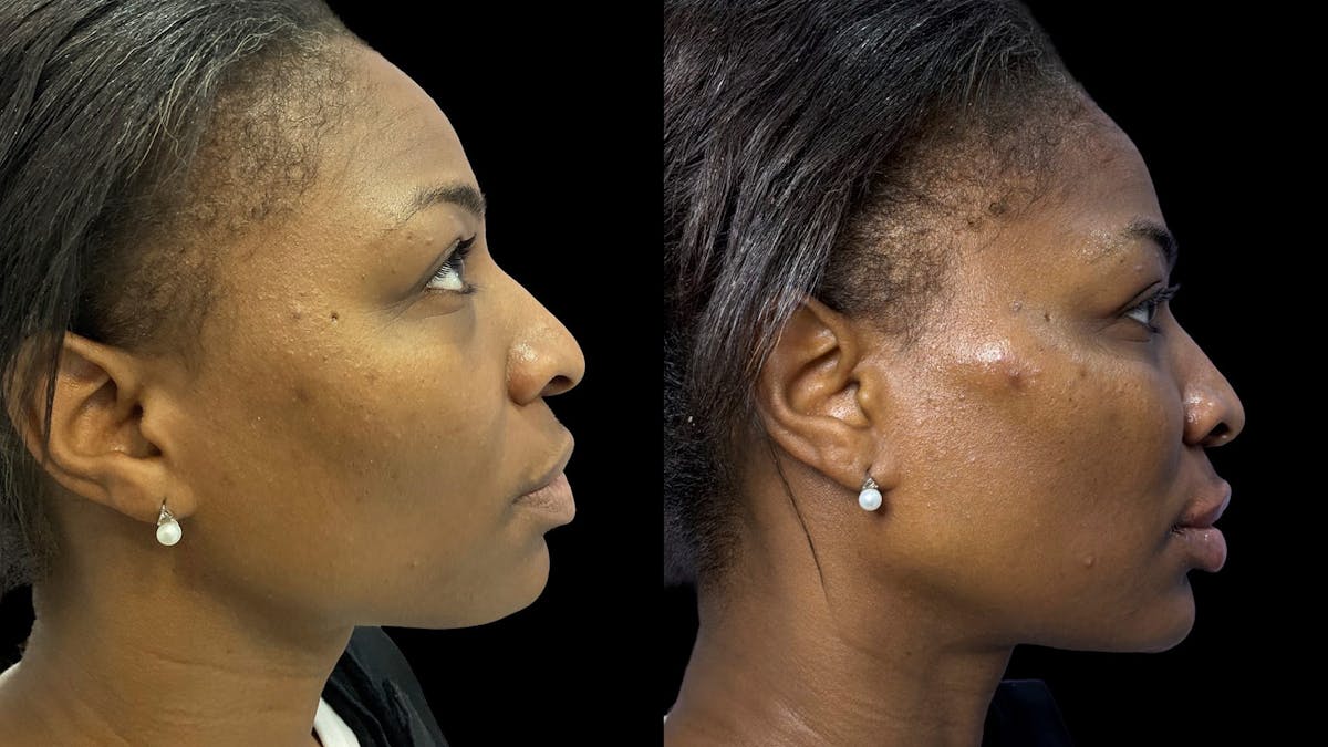 Dermal Filler Before & After Gallery - Patient 324589 - Image 3