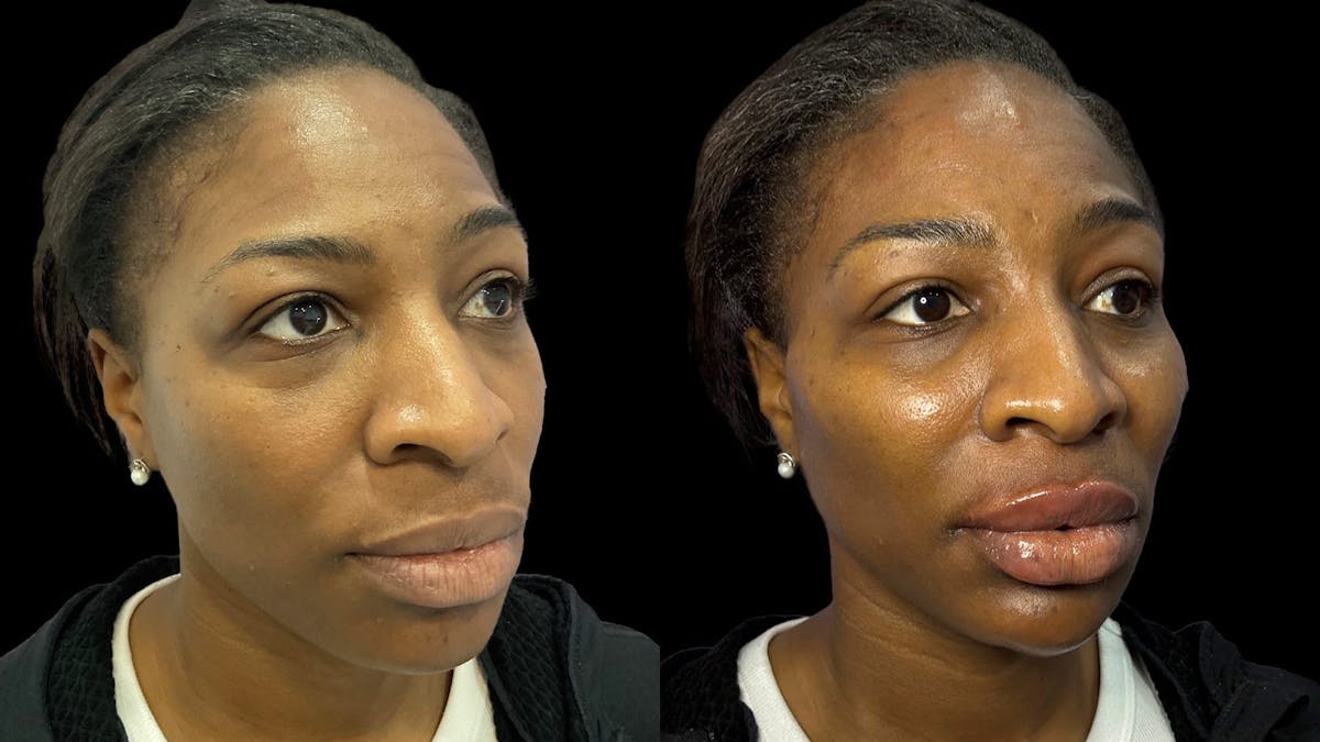 Dermal Filler Before & After Gallery - Patient 324589 - Image 2