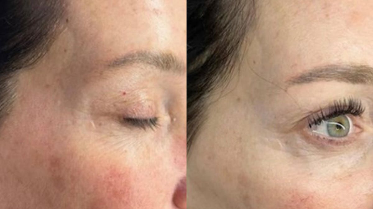 Exosomes Before & After Gallery - Patient 238370 - Image 1