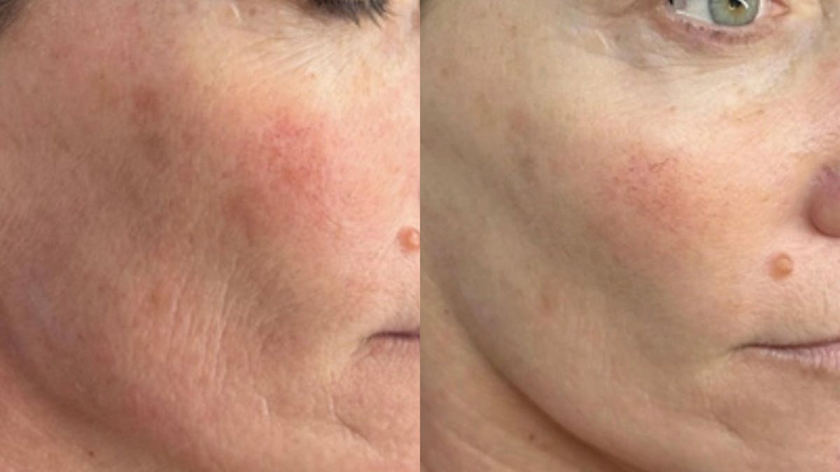 Exosomes Before & After Gallery - Patient 238370 - Image 2