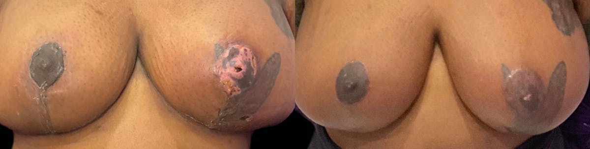 Exosomes Before & After Gallery - Patient 190266 - Image 3