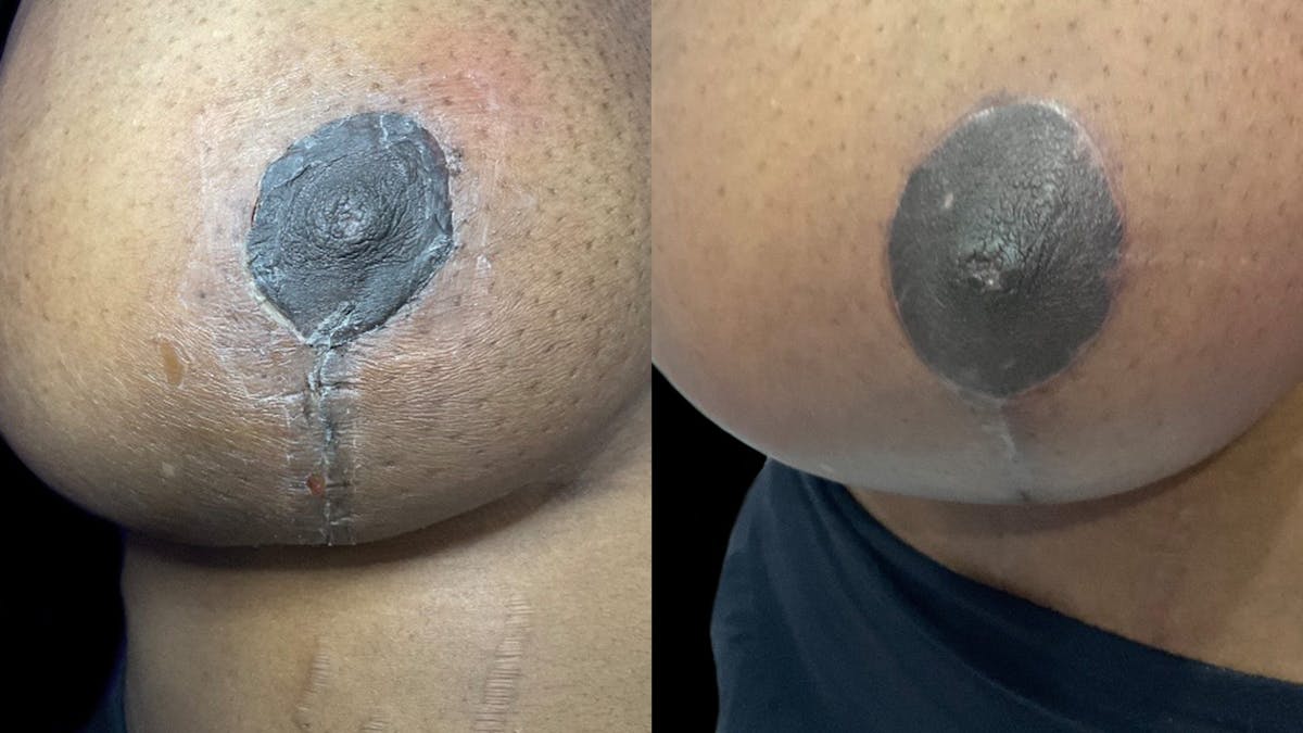 Exosomes Before & After Gallery - Patient 190266 - Image 2