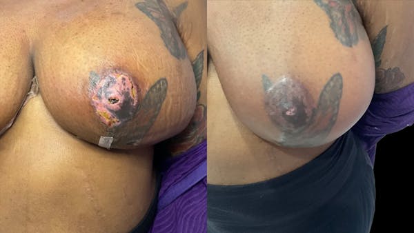 Exosomes Before & After Gallery - Patient 190266 - Image 1