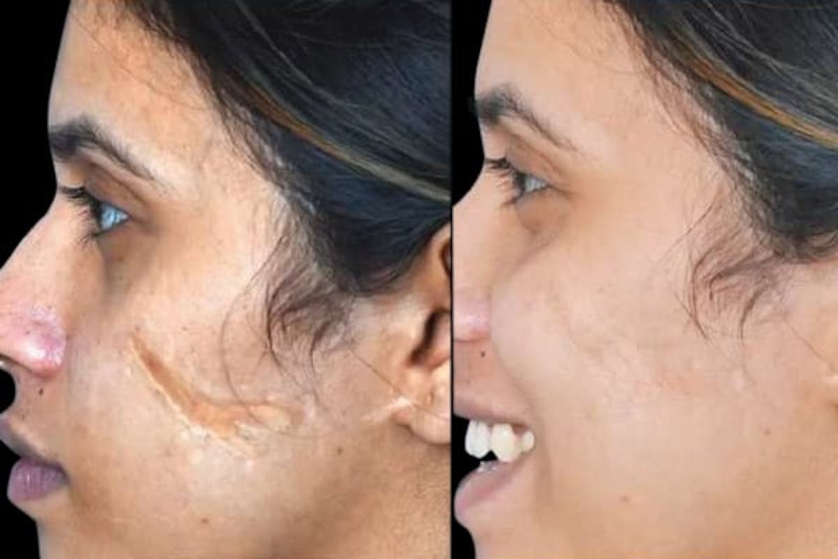 Exosomes Before & After Gallery - Patient 277378 - Image 1