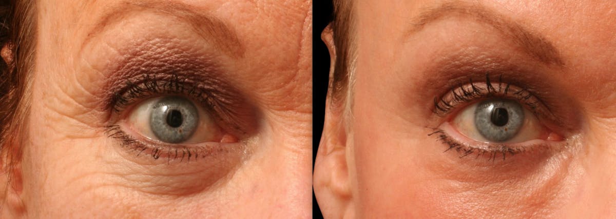 Exosomes Before & After Gallery - Patient 389530 - Image 2