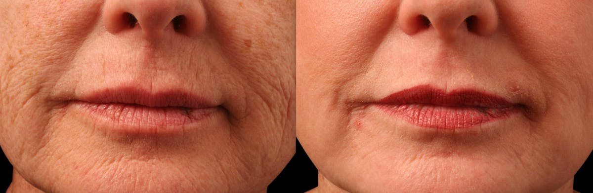 Exosomes Before & After Gallery - Patient 389530 - Image 1