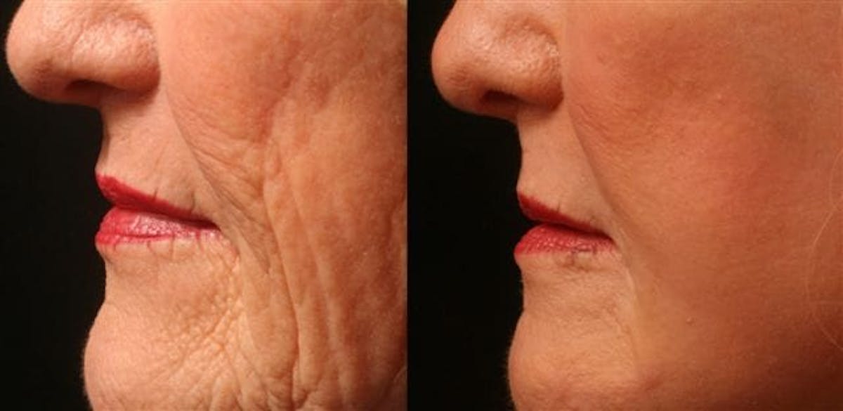 Exosomes Before & After Gallery - Patient 389530 - Image 3