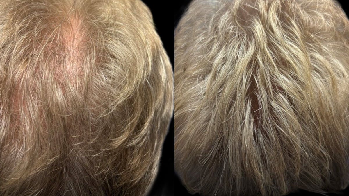 Exosomes Before & After Gallery - Patient 274025 - Image 1