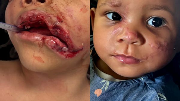 Facial Reconstruction Before & After Gallery - Patient 214219 - Image 1