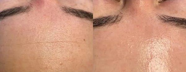 Geneo Before & After Gallery - Patient 138287 - Image 1