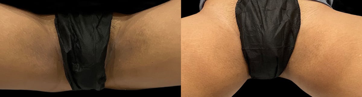 Intimate Skin Lightening Before & After Gallery - Patient 342762 - Image 1