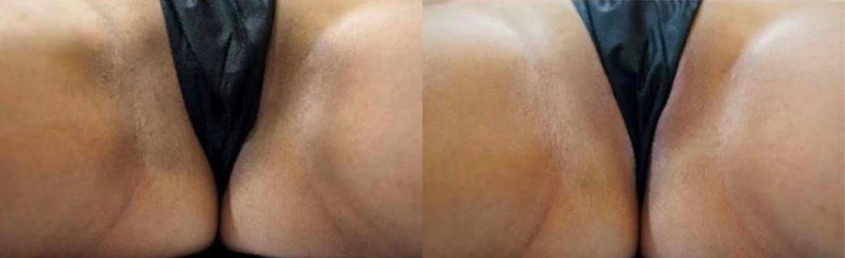 Intimate Skin Lightening Before & After Gallery - Patient 149663 - Image 1