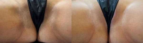 Intimate Skin Lightening Before & After Gallery - Patient 149663 - Image 1