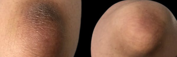 Intimate Skin Lightening Before & After Gallery - Patient 288350 - Image 1