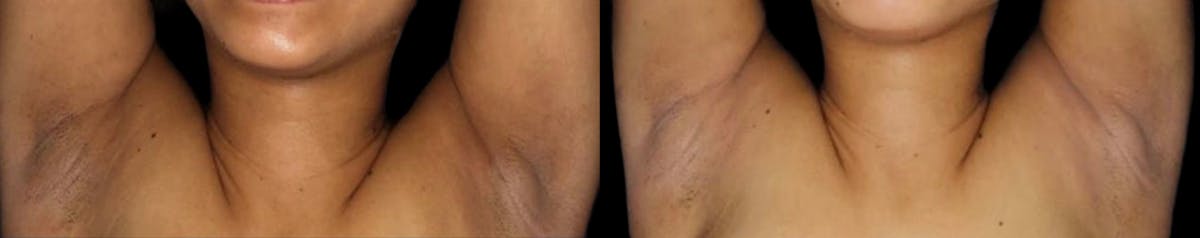 Intimate Skin Lightening Before & After Gallery - Patient 315533 - Image 1
