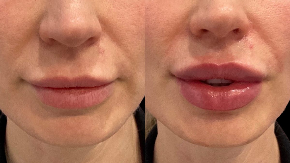 Lip Filler Before & After Gallery - Patient 400847 - Image 2