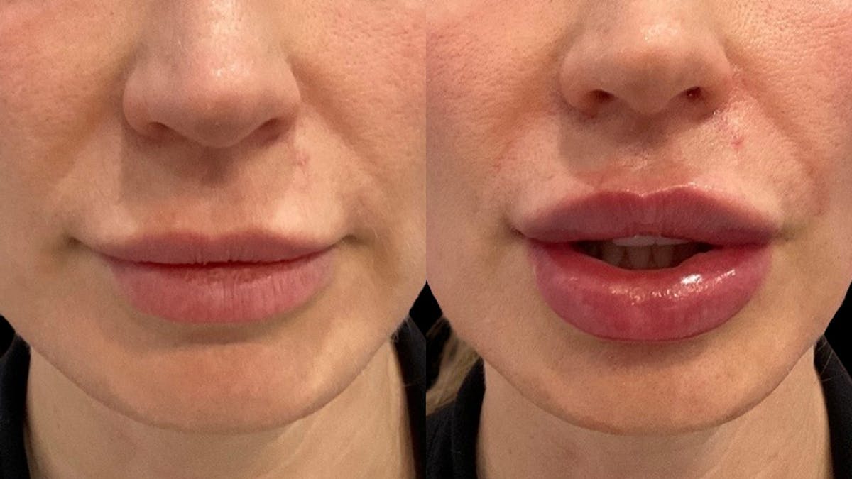 Lip Filler Before & After Gallery - Patient 400847 - Image 1