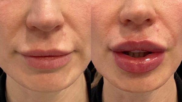 Lip Filler Before & After Gallery - Patient 400847 - Image 1